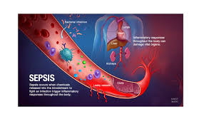 Steve alberts gives an update on liver cancer treatments. Mayo Clinic Health Video Dangers Of Sepsis Now Require Response Teams In Intensive Care Units Boomers Daily