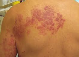 Incidența acestei afecțiuni în rândul copiiilor este foarte redusă. Classical Presentation Of Herpes Zoster Thoracicus Download Scientific Diagram