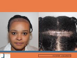 Lowering of frontal line in a woman with afro hair