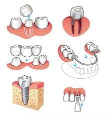Happy Family Day Everyone What A Great Summary Of Restorative Dental Procedures Top Left Crown Original Tooth Is Prep Dental Dental Life Dental Health
