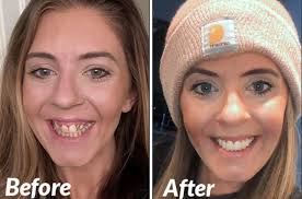 Cosmetic Dentistry Case Study Lakewood