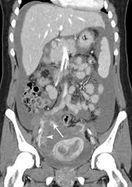 Most tumors arise from the pleura, and so this article will focus on pleural mesothelioma. Erkrankungen Von Peritoneum Und Mesenterium Springerlink