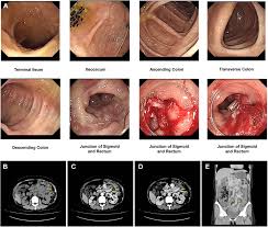 Image result for Colonoscopy in GI Bleeding