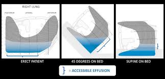 If a unilateral pleural effusion is thought to be exudative, british thoracic society guidelines suggest pleural fluid aspiration (diagnostic) which is usually performed under ultrasound guidance.5. Lung Ultrasound Pleural Effusion Litfl Ultrasound Library