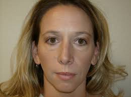 Blepharoplasty or Eyelid Surgery Photos