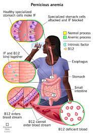 Pernicious Anemia: Definition, Symptoms, Causes & Treatment