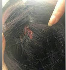 Ddhhsutra2012 On Twitter Estudiante Del L1 Herida Por Lacrimogena En La Cabeza Lanzada Por Ffee Carabdechile Cc Megafonopopular Rvfradiopopular Prensaopal Izquierda Tuit Periodistafigue Marxismo Cl Https T Co A2jfjaq6gp Twitter