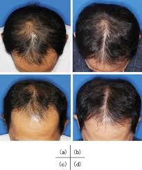 Researchers tried to clone new hair follicles that were grown from the stem cells harvested from the back of the head. Aape Stem Cell Hair Loss Therapy Trichology Centre Toronto