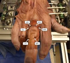 Image result for Elson Extensor Tendon Test