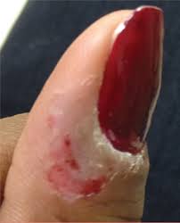 Image result for Neurotic Excoriation