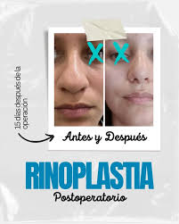 📍POLICLÍNICA TÁCHIRA, TORRE 3, PISO 6, CONSULTORIO 7 SAN CRISTÓBAL,  TÁCHIRA, VENEZUELA ✓ Dr. Nelson Negrón. 👉🏼Cirujano Plástico. @dr_negron  Alta estética corporal a tu alcance _ #DrNegron #CirugiaPlastica  #CirugiaReconstructiva #Estetica ...