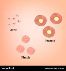 Image result for Pustule