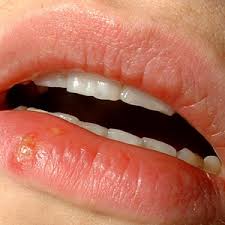 Herpetic gingivostomatitis is often the initial presentation during the first (primary) herpes simplex infection. Herpes Center For Young Women S Health
