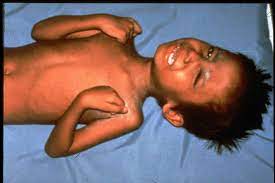 Tetanus Images | Immunize.org