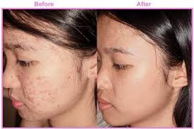 In the pictures below you can see the benefits of retin a in both anti aging, and acne reduction. Generic Retin A Tretinoin Home Facebook