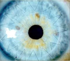 Getting Stitches In Your Eyeball Is Surprisingly Beautiful Eyeball Corneal Transplant Eye Health