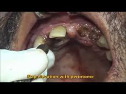 You might come across a bump or sore in your mouth that doesn't seem to heal. Full Mouth Extraction Due To Periodontitis Youtube