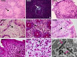 It level plodovnica po kapljicah sunday funday ex 2012 tarik phillips wvu scottish wool, per fisher. Whipple S Disease In Granulomatous Disguise A Challenging Diagnosis With Many Histopathological Pitfalls Springerlink