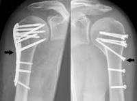 How to enhance the stability of locking plate fixation of ...