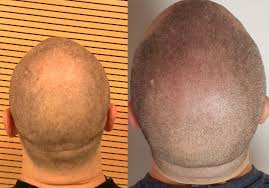 Fondamentalmente la micropigmentazione è definita come un tipo di tatuaggio che include la tecnica del microblading. Tricopigmentazione Roma Riccardo Marchi