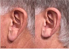 Skin cancer is one of the most common types of cancer. Earlobe Reduction Sandy Springs Ear Plastic Surgery Dunwoody