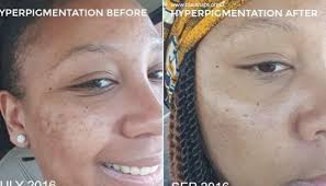 My All Natural Mix Continues To Improve My Hyperpigmentation At A Fragment Of The Cost In 2020 Hyperpigmentation Natural Skin Care Regimen Hyperpigmentation Treatment