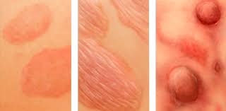 Per linfoma si intende un gruppo di tumori del tessuto linfoide (linfociti t e b, nk e loro precursori). Linfomas Cutaneos Que Son Y Cuales Son Los Mas Frecuentes Skinnews Revista Dermocosmetica