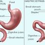 gastric bypass surgery from www.healthdirect.gov.au