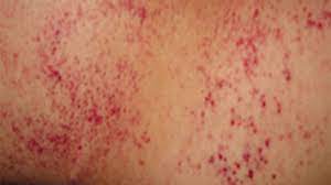 It is characterized by a triad of palpable purpura (without thrombocytopenia), abdominal pain, and arthritis. Petechiae Causes Treatments Pictures And More