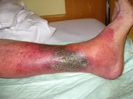 Image result for erysipel photos)