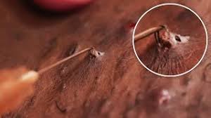 The condition is most prevalent among people who have coarse or curly hair. Getting Rid Of Ingrown Hair Down There Youtube