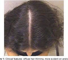 This type of hair loss on females can cause the hair to fall faster than usual all over the scalp. Pdf Diffuse Hair Loss In A Young Female Semantic Scholar
