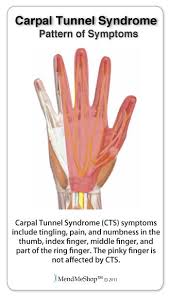 Common Carpal Tunnel Syndrome Symptoms Include Tingling Or Numbness You May Experience Tingling And Numbness Carpal Tunnel Carpal Tunnel Syndrome Hand Wrist