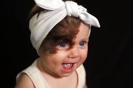 Wollongong girl Ruby Ashby faces surgery to remove a rare birthmark