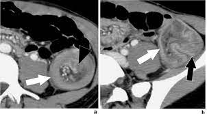 Check spelling or type a new query. Colocolic Intussusception Secondary To A Descending Colon Download Scientific Diagram