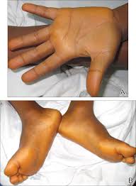The hair specifically requires fat soluble vitamins a & e to nourish the roots and scalp, and red palm oil specifically is not only very high in vitamin e, but also in beta carotene. Carotenoderma Associated With A Diet Rich In Red Palm Oil Mdedge Dermatology