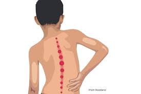 Apabila siti hawa dijadikan dari salah satu tulang rusuk adam, maka tentu ada satu tulang rusuk adam yang berkurang di sebelah kanan atau sebelah kiri, yang akan menurun menjadi warisan anak cucu adam. Atasi Skoliosis Tanpa Operasi Ini Caranya Lifestyle Bisnis Com
