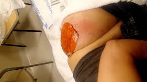 Vaginal boils are inflamed bumps filled with pus that occurs on the outside skin of the vagina. Giant Back Abscess Gets Drained Youtube