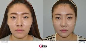 Pin On V Line Surgery Before And After Korean Surgery