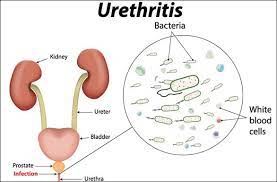 See full list on draxe.com Herbal Remedies For Urethritis Ayurvedic Treatment Causes Symptoms