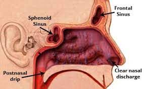 Allergic Rhinitis Definition Welcomecure