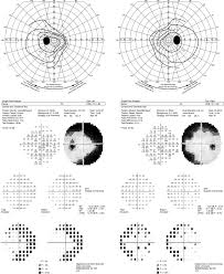 Image result for Visual Field Deficit