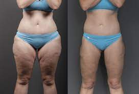 Thigh Lift Sydney Bella Vista New South Wales Dr Gavin Sandercoe