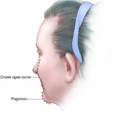 Also a sine function because said cheek is put in. Creation Of A Youthful Cheek Apex At Swift S Point A Swift S Point Download Scientific Diagram