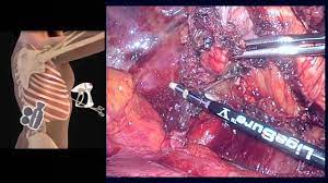 Here are some guidelines you should follow for h. Video Assisted Thoracoscopic Extrapleural Pneumonectomy For Malignant Pleural Mesothelioma Youtube