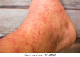 Image result for allergy rash on the legs
