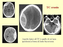 Un'emorragia cerebrale sta sanguinando dentro o intorno al cervello. La Patologia Traumatica Craniocerebrale Oggi Uno Dei Pi