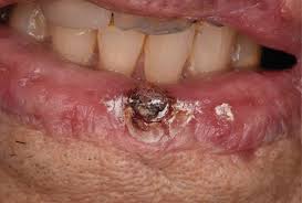 Image result for Lip Cancer