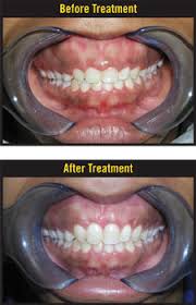 Can a gummy smile be fixed? How To Fix A Gummy Smile Blog