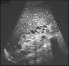 Renal depend on the position of the stone. Chronic Renal Failure Radiology Key
